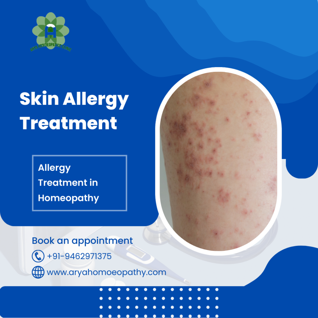 Effective Homeopathic Treatment for 6 Common Skin Diseases Offered at Arya Homeopathy